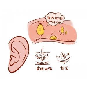 耳朵里耳屎多，到底要不要掏，正確處理方式是？