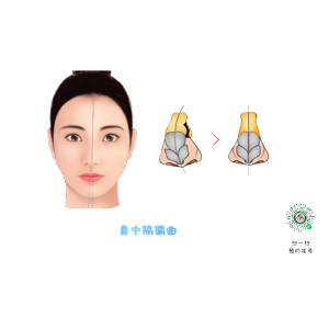 兒童鼻中隔能矯正？最佳干預(yù)年齡！