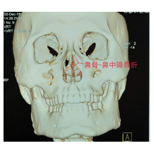 貴陽(yáng)銘仁耳鼻喉醫(yī)院提醒您：鼻子很脆弱，要好好保護(hù)
