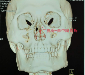 十歲小孩被書本砸破鼻子，(圖1)