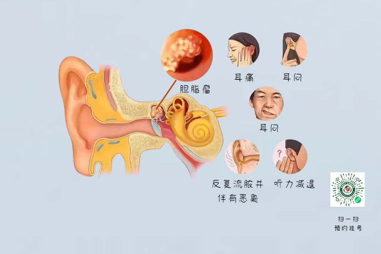 手術(shù)沒做干凈，術(shù)后3年顱內(nèi)竟發(fā)現(xiàn)巨大膽脂瘤！(圖6)