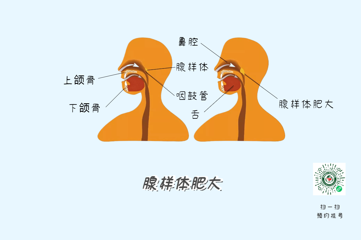 暑假來(lái)了，孩子腺樣體肥大到底切不切？(圖4)