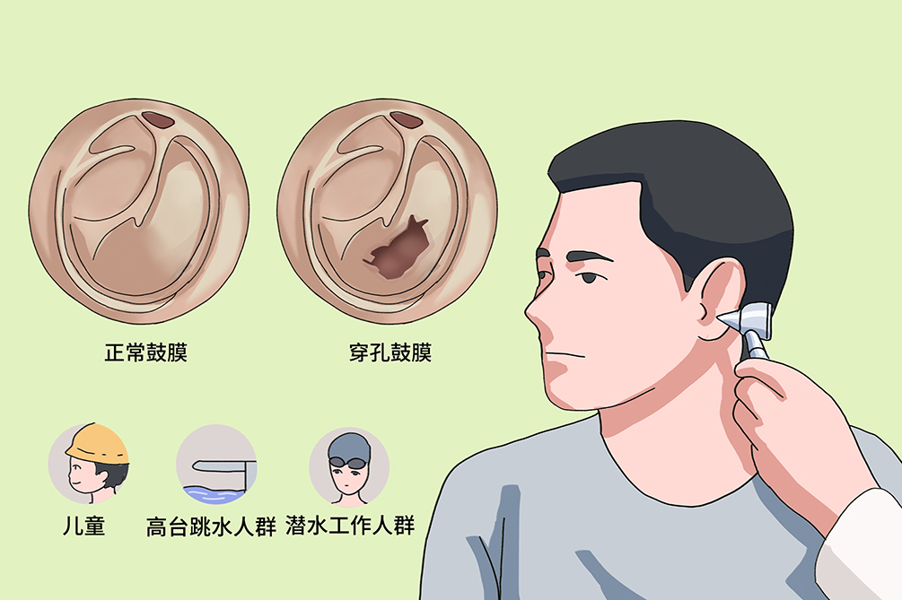 鼓膜穿孔不及時治療，會導致聽力下降，甚至引發(fā)顱內感染？(圖3)