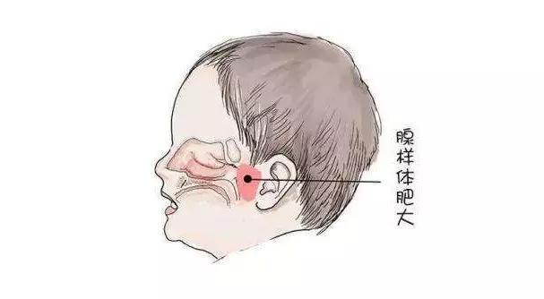 專家分享：父母注意！孩子腺樣體肥大如果忽略，后果很嚴重！(圖1)