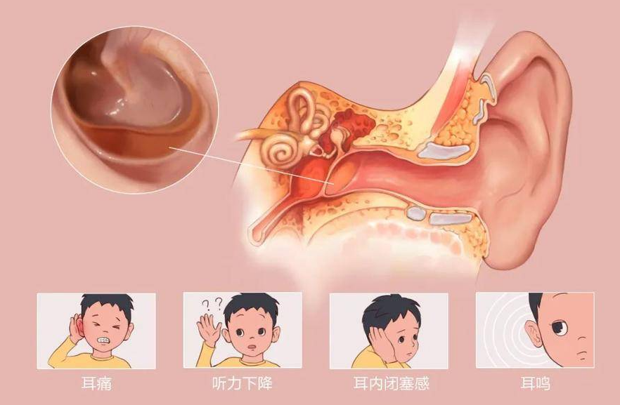 耳朵里耳屎多，到底要不要掏，正確處理方式是？(圖2)