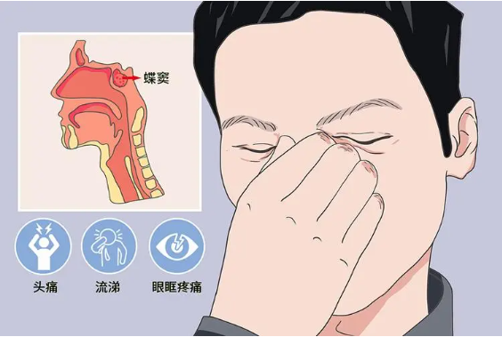 頭疼、眼痛雖小，卻可能是蝶竇炎發(fā)出的警告信號！(圖1)