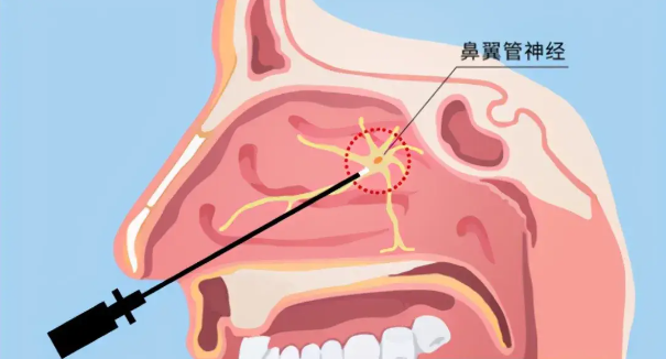 頭疼、眼痛雖小，卻可能是蝶竇炎發(fā)出的警告信號！(圖2)