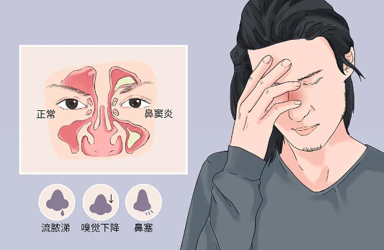鼻竇炎不及時(shí)治療，會(huì)危及生命？？？(圖2)