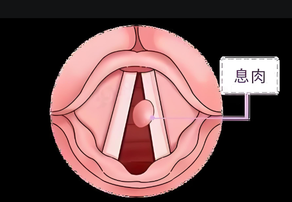 聲音嘶啞、嗓子難受，聲帶息肉不可小覷(圖1)