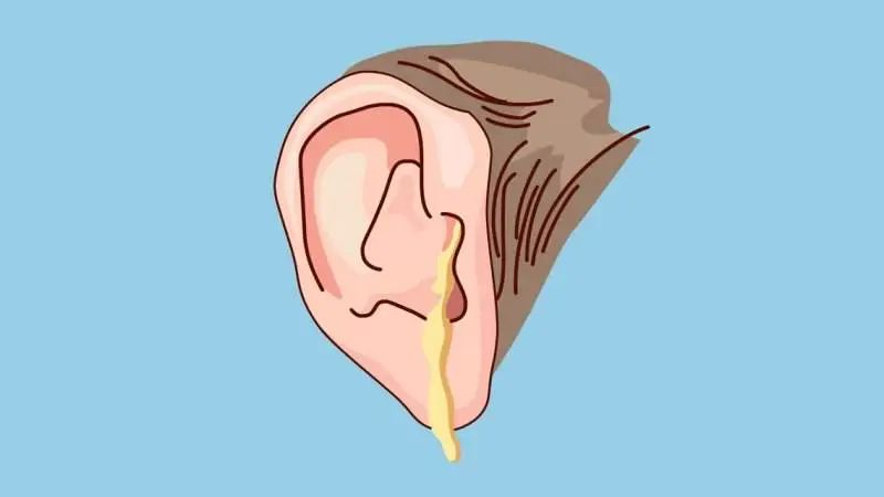 中耳炎會(huì)引起面癱，是真的嗎？(圖2)