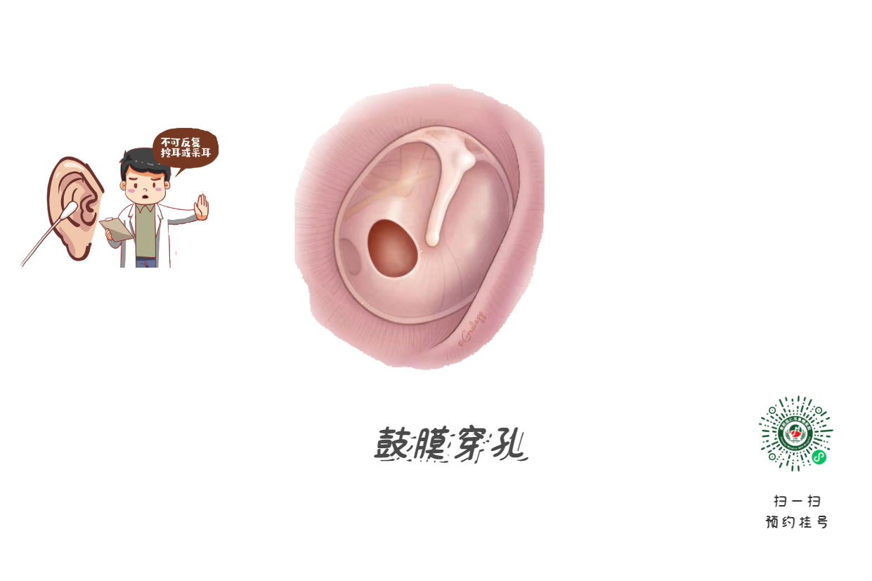 掏耳朵竟致顱內(nèi)感染？這5個習(xí)慣快改掉(圖2)