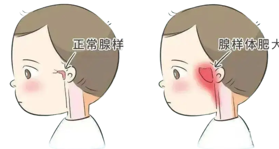 孩子腺樣體肥大影響發(fā)育和容貌，趁五一假期，微創(chuàng)治療快速治愈！(圖1)