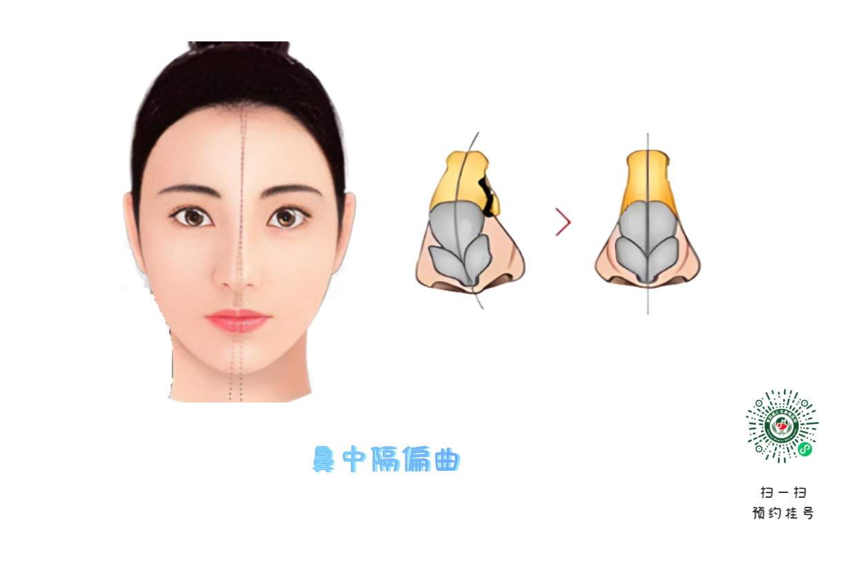 兒童鼻中隔能矯正？最佳干預(yù)年齡！(圖1)