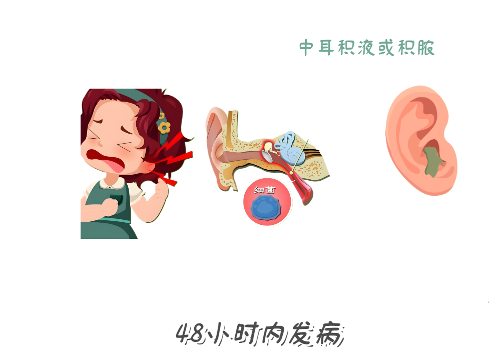 耳朵痛到睡不著？急性中耳炎急救法！(圖2)