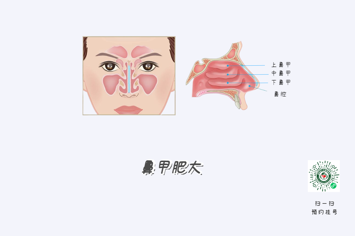 頭痛欲裂？可能是鼻竇炎在作祟！(圖2)